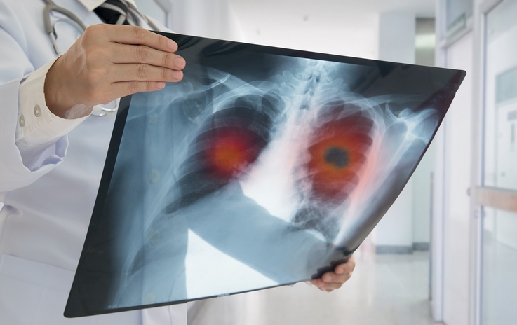  Nowe metody leczenia raka płuca – rosną szanse medycyny w walce z tym nowotworem